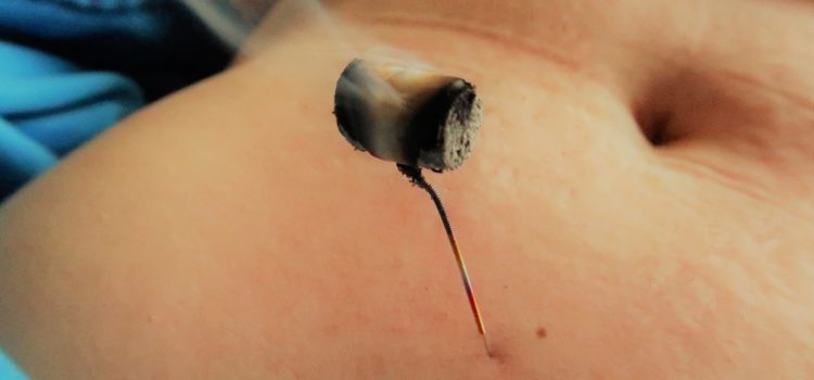 La moxibustion 灸法